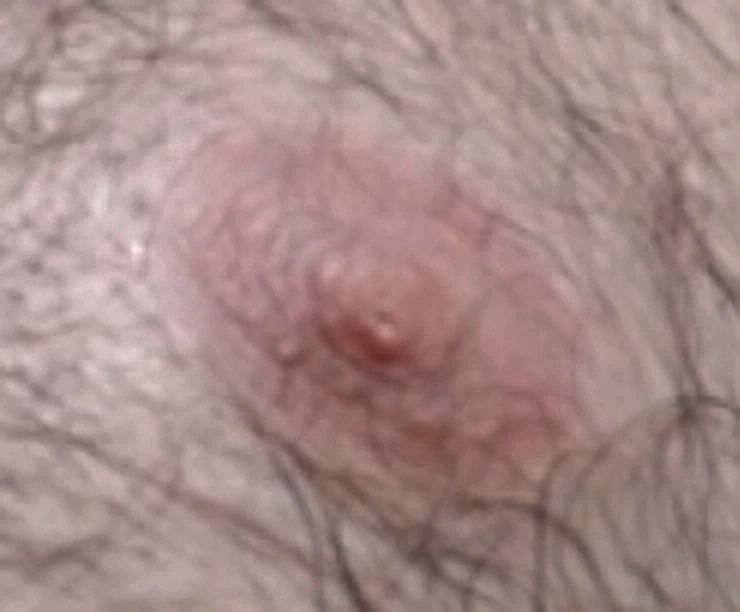 Mellbimbó közelről